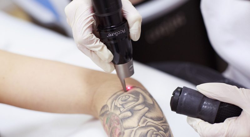 Pašalinti tatuiruočių išlaidas