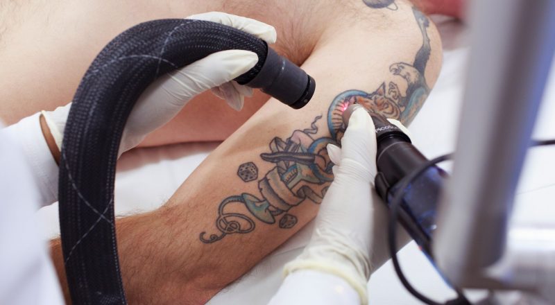 Pašalinti tatuiruotę su lazeriu