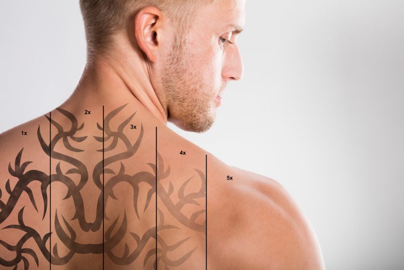 Tatuiruotojo lazerio pašalinimo etapai