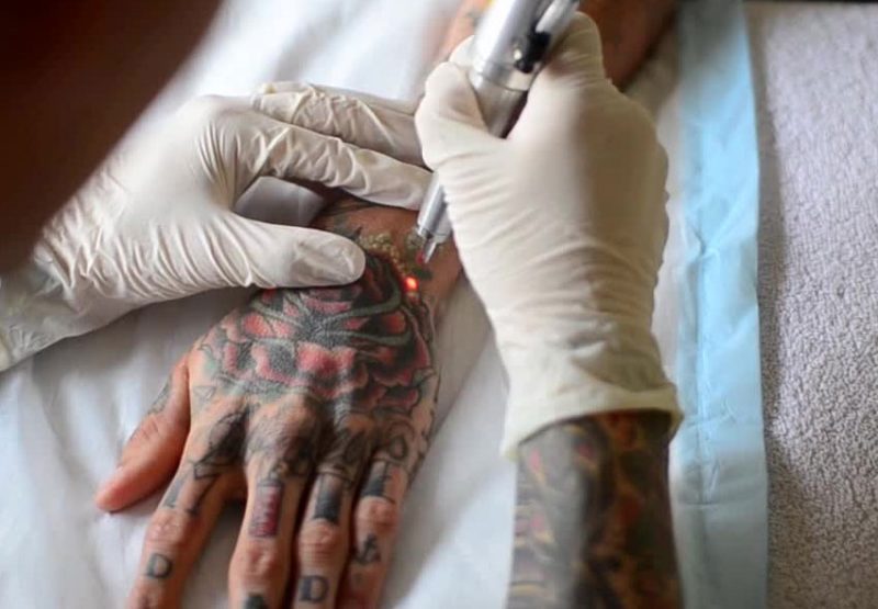 Tatuiruočių pašalinimo patirtis